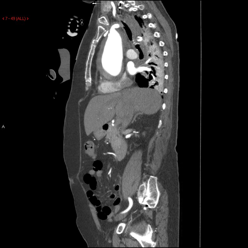 Aortic intramural hematoma (Radiopaedia 27746-28001 C 18).jpg