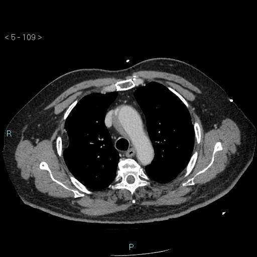 Aortic intramural hematoma (Radiopaedia 48463-53380 C 49).jpg