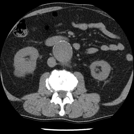 Aortic intramural hematoma (type B) (Radiopaedia 79323-92387 Axial non-contrast 72).jpg