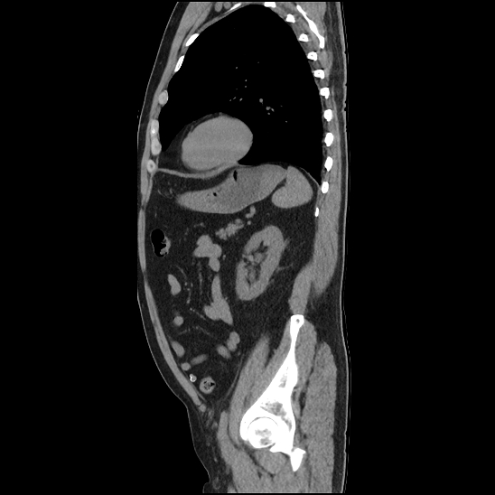 Aortic intramural hematoma (type B) (Radiopaedia 79323-92387 G 40).jpg