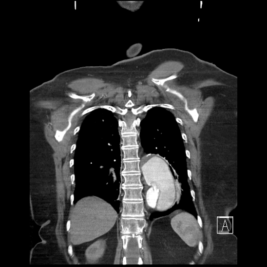 File:Aortic intramural hematoma with dissection and intramural blood pool (Radiopaedia 77373-89491 C 52).jpg