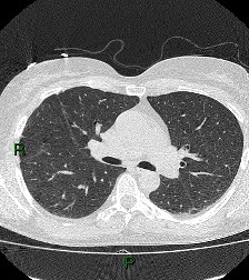 File:Aortic valve endocarditis (Radiopaedia 87209-103485 Axial lung window 45).jpg