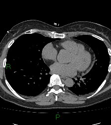 Aortic valve endocarditis (Radiopaedia 87209-103485 Axial non-contrast 63).jpg