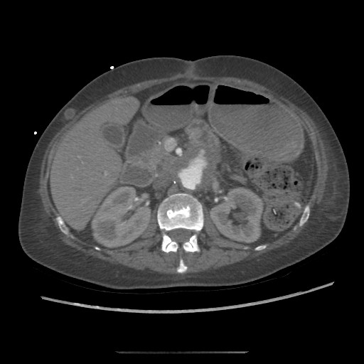 Aorto-duodenal fistula (Radiopaedia 25668-25850 A 23).jpg