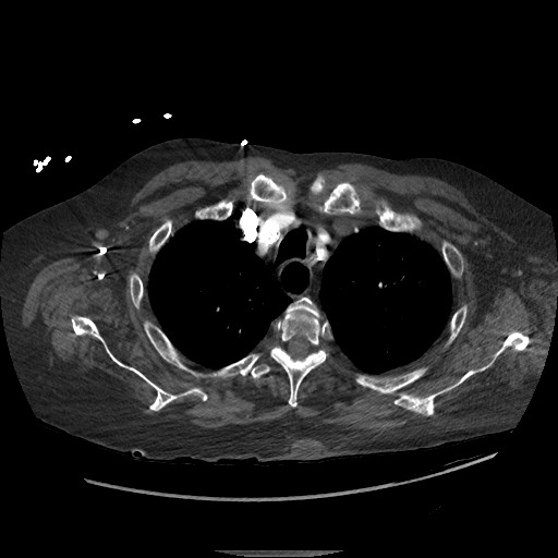 Aortoesophageal fistula with endovascular repair (Radiopaedia 73781-84592 Axial C+ CTPA 17).jpg