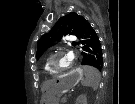 File:Aortoesophageal fistula with endovascular repair (Radiopaedia 73781-84592 Sagittal C+ CTPA 130).jpg