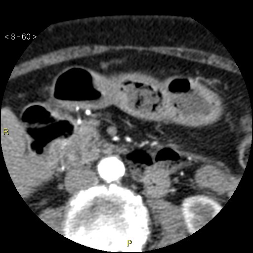 Aortoiliac occlusive disease (Radiopaedia 16828-16548 A 60).jpg