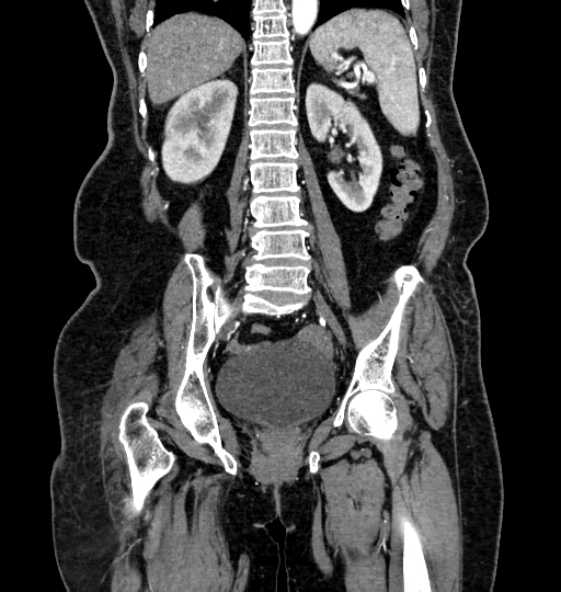 Aortoiliac occlusive disease (Radiopaedia 52352-58248 B 50).jpg