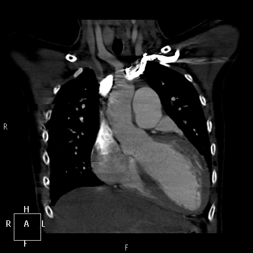 File:Aortopulmonary septal defect (Radiopaedia 41990-45013 Coronal C+ CTPA 18).jpg