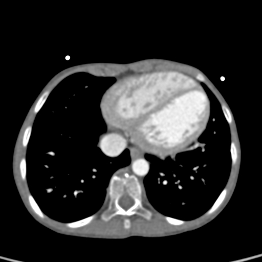 File:Aortopulmonary window, interrupted aortic arch and large PDA giving the descending aorta (Radiopaedia 35573-37074 B 71).jpg