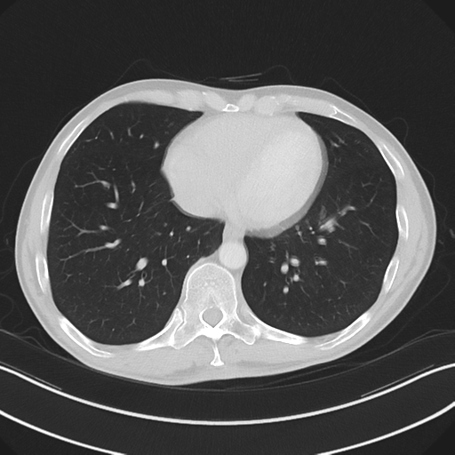 Apical pleural calcification (Radiopaedia 46141-50499 Axial lung window 50).png