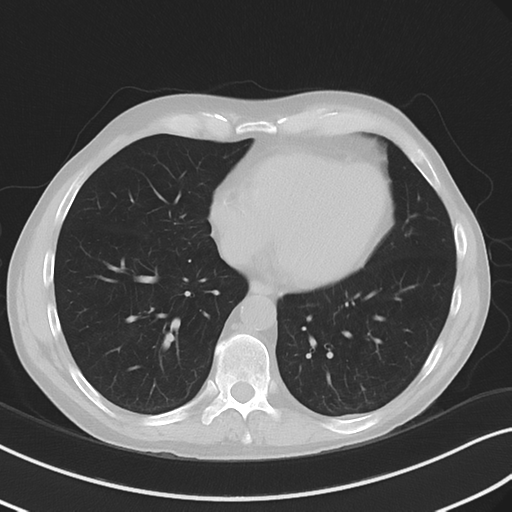File:Apical pulmonary metastasis (Radiopaedia 46338-50754 Axial non-contrast 45).png