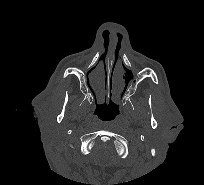 Aplastic maxillary sinuses (Radiopaedia 60030-67561 Axial non-contrast 20).jpg