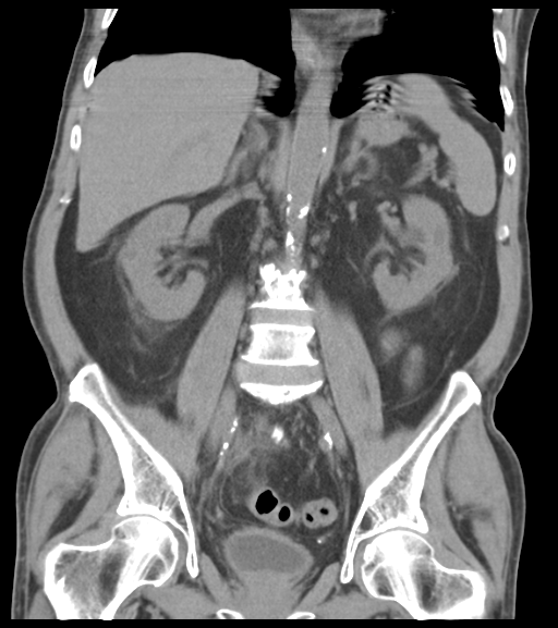 File:Appendiceal abscesses (Radiopaedia 50999-56542 Coronal non-contrast 35).png