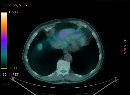 Appendiceal adenocarcinoma complicated by retroperitoneal abscess (Radiopaedia 58007-65041 Axial PET-CT 97).jpg