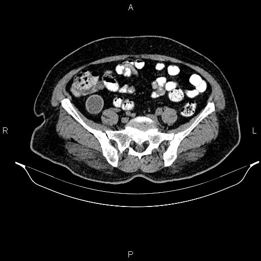 File:Appendiceal mucocele (Radiopaedia 82952-97298 A 75).jpg