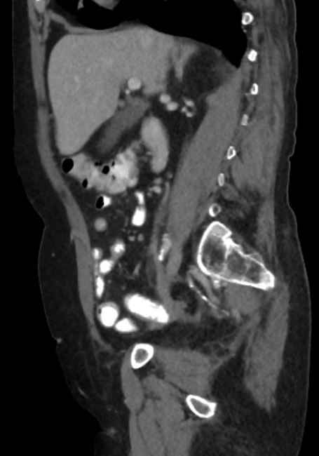 Appendicitis due to chicken fibula (Radiopaedia 74314-85198 C 37).jpg
