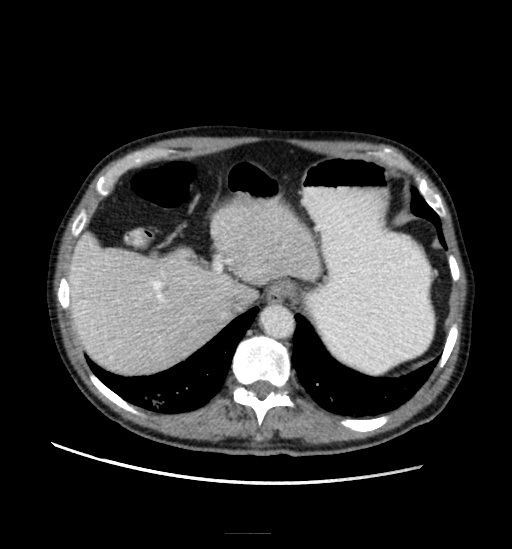 File:Appendicitis with localized perforation and abscess formation (Radiopaedia 49035-54130 A 21).jpg