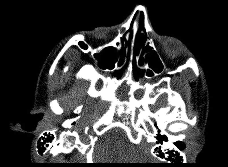 File:Arachnoid cyst- extremely large (Radiopaedia 68741-78450 Axial bone window 3).jpg
