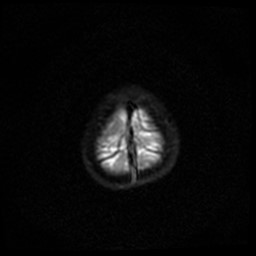 Arachnoid cyst - middle cranial fossa (Radiopaedia 86780-102938 Axial DWI 31).jpg