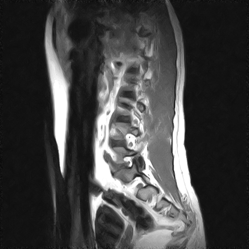 File:Arachnoid cyst - spinal (Radiopaedia 66835-76157 Sagittal T1 10).jpg