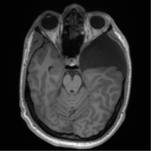 File:Arachnoid cyst with subdural hematoma (Radiopaedia 85892-101743 Axial T1 34).png