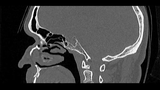 File:Arcuate foramen (Radiopaedia 89833-106944 Sagittal bone window 74).jpg