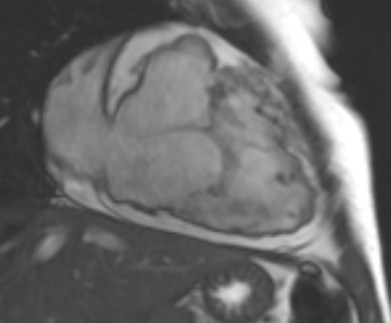 File:Arrhythmogenic right ventricular cardiomyopathy (Radiopaedia 69431-79307 2ch cine 59).jpg