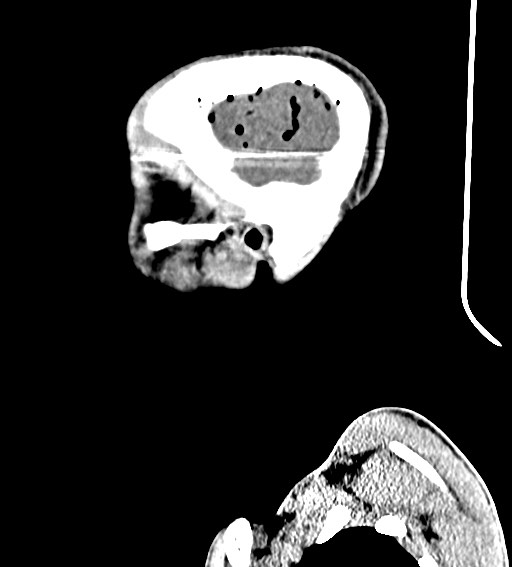 Arrow injury to the brain (Radiopaedia 72101-82607 H 53).jpg