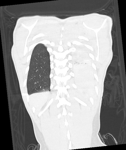 Arrow injury to the chest (Radiopaedia 85367-100975 Coronal lung window 110).jpg