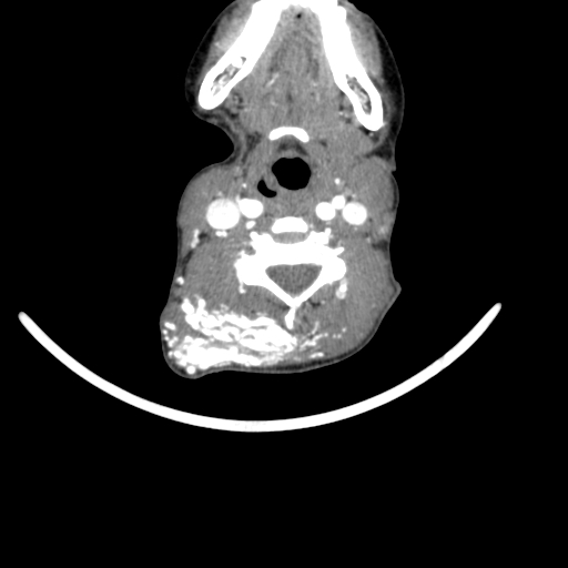 Arteriovenous malformation of the neck (Radiopaedia 53935-60062 A 30).jpg