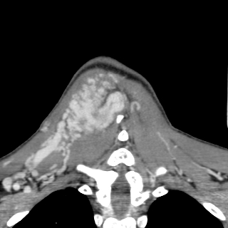 Arteriovenous malformation of the neck (Radiopaedia 53935-60062 D 46).jpg