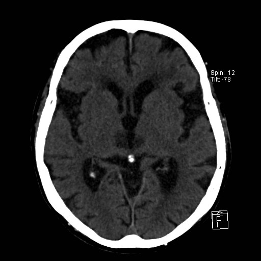 File:Artery of Percheron infarction (Radiopaedia 26307-26439 Axial non-contrast 14).jpg