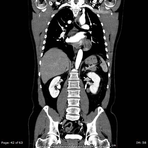 Ascending aortic aneurysm (Radiopaedia 50086-55404 B 42).jpg