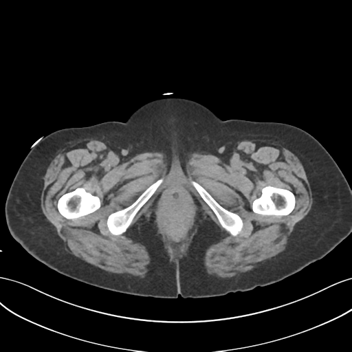 File:Ascending cholangitis (Radiopaedia 39068-41253 Axial non-contrast 74).png