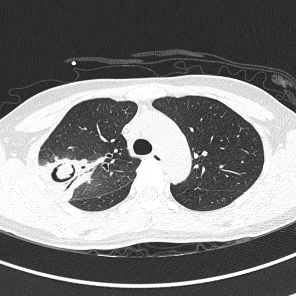 Aspergilloma (Radiopaedia 26223-26347 Axial lung window 25).jpg