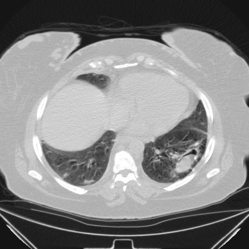 Aspergilloma (Radiopaedia 39611-41932 Axial lung window 92).jpg