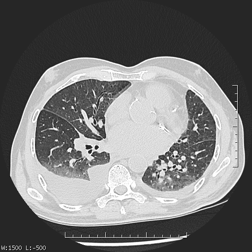 File:Aspergilloma (Radiopaedia 75184-86270 Axial lung window 30).jpg