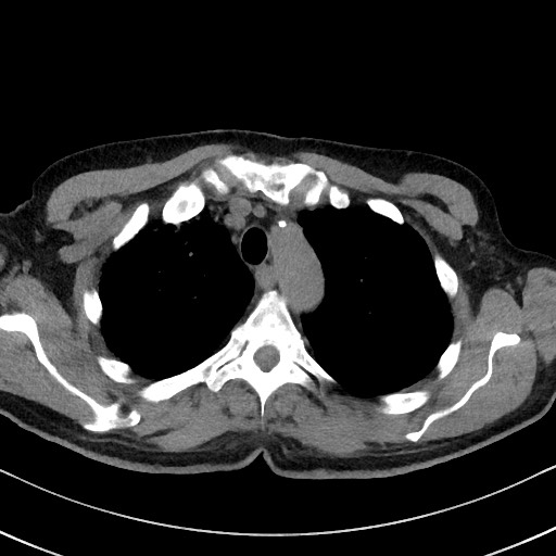 Aspergilloma on background pulmonary fibrosis (Radiopaedia 60942-68757 Axial non-contrast 15).jpg