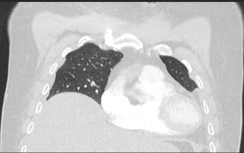 Aspirated tooth (Radiopaedia 28584-28844 Axial lung window 38).jpg