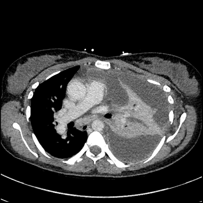 Aspiration pneumonia complicated by empyema (Radiopaedia 73024-83767 B 155).jpg