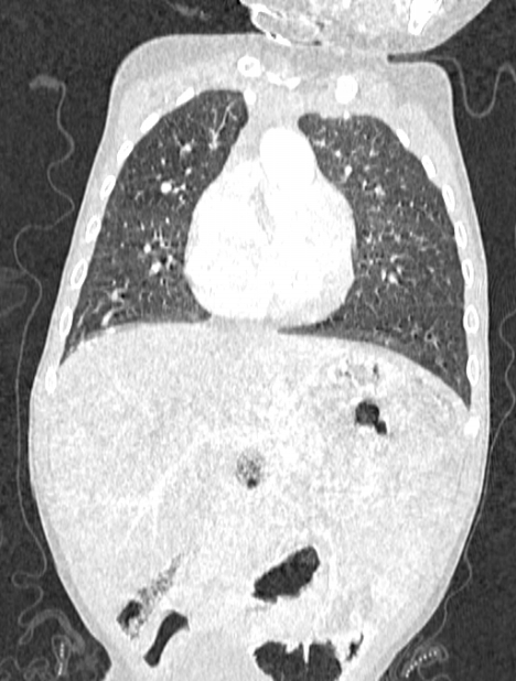 Asplenia syndrome (Radiopaedia 73083-83792 Coronal lung window 49).jpg