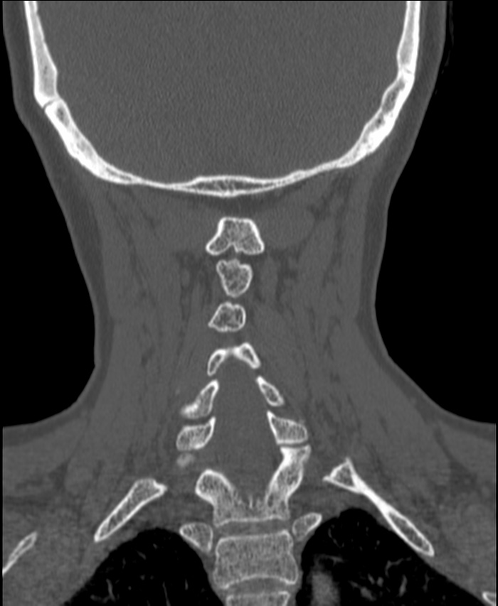 Atlanto-occipital assimilation with basilar invagination (Radiopaedia 70122-80188 Coronal bone window 166).jpg