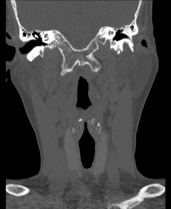 Atlanto-occipital assimilation with basilar invagination (Radiopaedia 70122-80188 Coronal bone window 40).jpg