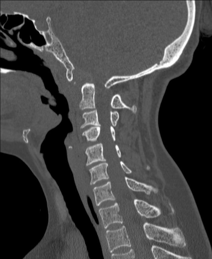 Atlanto-occipital assimilation with basilar invagination (Radiopaedia 70122-80188 Sagittal bone window 79).jpg