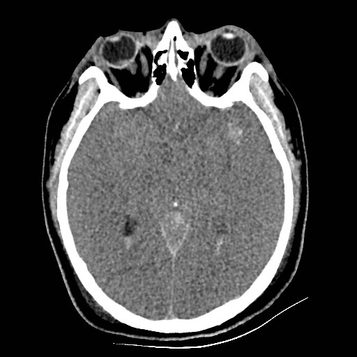 Atlanto-occipital dislocation (Radiopaedia 44648-48412 Axial non-contrast 25).jpg