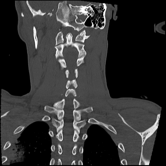 Atlanto-occipital dissociation (Traynelis type 1), C2 teardrop fracture, C6-7 facet joint dislocation (Radiopaedia 87655-104061 Coronal bone window 45).jpg