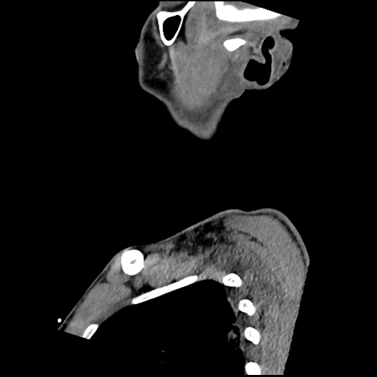 Atlanto-occipital dissociation (Traynelis type 1), C2 teardrop fracture, C6-7 facet joint dislocation (Radiopaedia 87655-104061 D 11).jpg