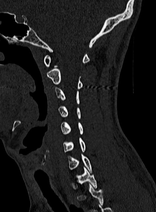 Atlantoaxial subluxation (Radiopaedia 44681-48450 Sagittal bone window 41).jpg