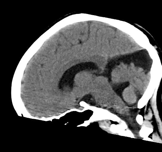 File:Atretic encephalocoele with inferior vermis hypoplasia (Radiopaedia 30443-31107 C 16).jpg